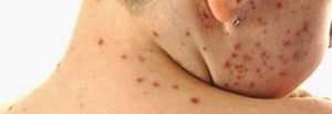 Allarme morbillo in Sicilia