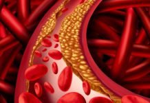 Colesterolo alto? Un nuovo farmaco aiuterà a ridurlo