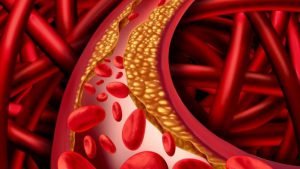 Colesterolo alto? Un nuovo farmaco aiuterà a ridurlo