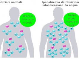 Intossicazione idrica
