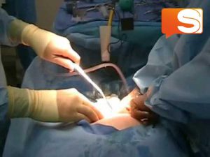 Neonato morto dopo il parto cesare