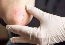 Psoriasi, in estate cosa fare