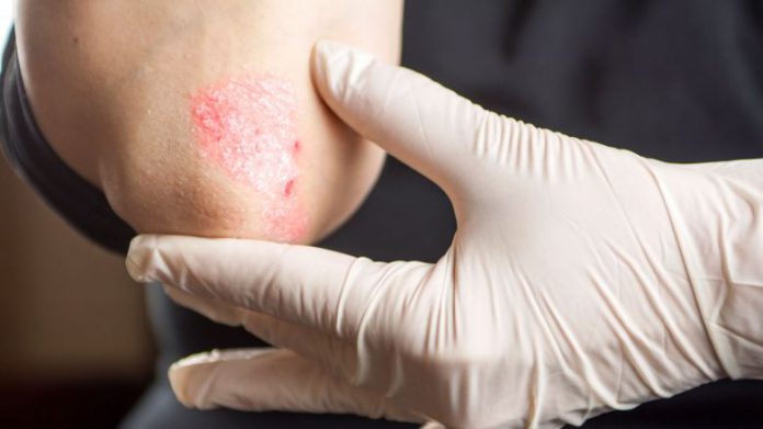 Psoriasi, incontro a Catania su possibili cure