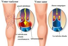 Vene varicose, cosa sono?