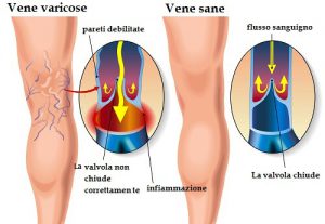 Vene varicose, cosa sono?